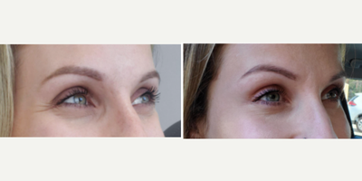 Botox before and after photo