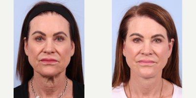 Deep Plane Facelift before and after photo