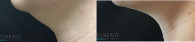 Kybella before and after photo