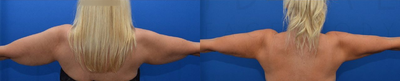 Arm Lift before and after photo