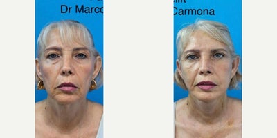 Facelift before and after photo