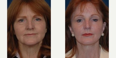 Facelift before and after photo