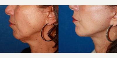 Neck Lift before and after photo