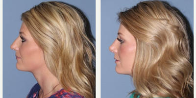 Rhinoplasty before and after photo