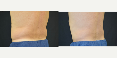 CoolSculpting before and after photo