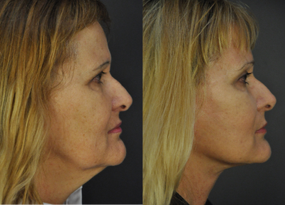Facelift before and after photo
