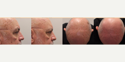 Fraxel Laser before and after photo
