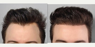 Hair Transplant before and after photo