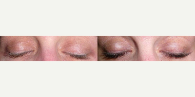Latisse before and after photo