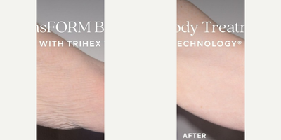 Alastin Skincare before and after photo
