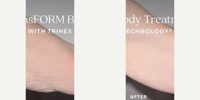Alastin Skincare before and after photo