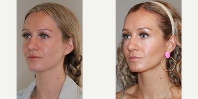 Dysport before and after photo