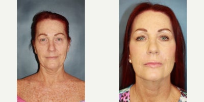 Facelift before and after photo