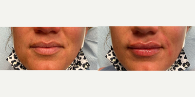 Restylane Kysse before and after photo