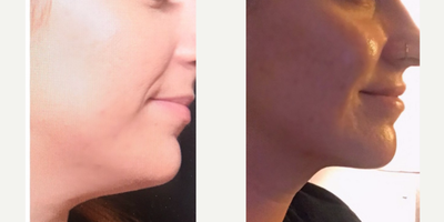 Skin Rejuvenation before and after photo