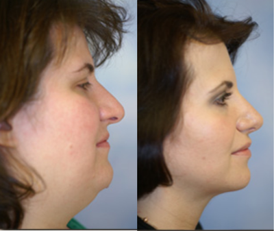Chin Liposuction before and after photo
