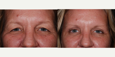 Eyelid Surgery before and after photo