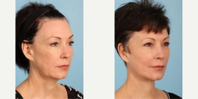 Facelift before and after photo