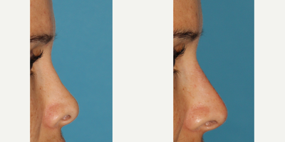 Nonsurgical Nose Job before and after photo