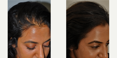 PRP for Hair Loss before and after photo