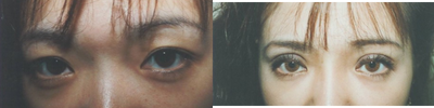 Eyelid Surgery before and after photo