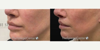 Lip Lift before and after photo
