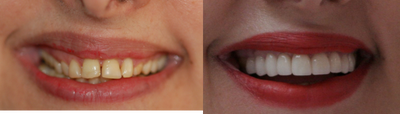 Smile Makeover before and after photo