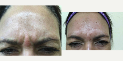 Botox before and after photo