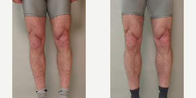 Calf Implant before and after photo