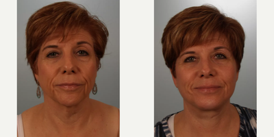 Facelift before and after photo