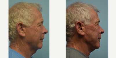Facelift before and after photo