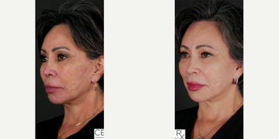 Opus Plasma before and after photo