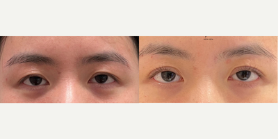 Dermal Fillers before and after photo