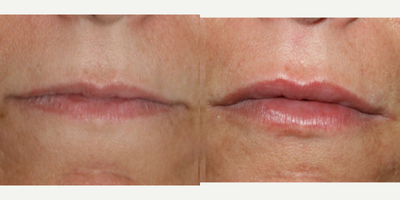Lip Fillers before and after photo
