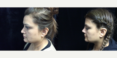 Revision Rhinoplasty before and after photo