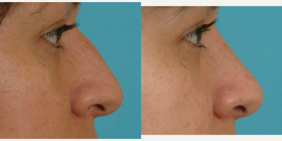 Rhinoplasty before and after photo