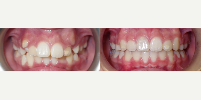 Braces before and after photo