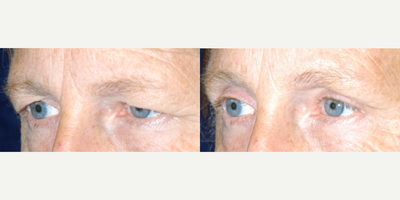 Brow Lift before and after photo
