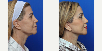 Brow Lift before and after photo