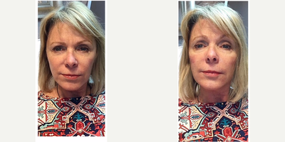Dermal Fillers before and after photo
