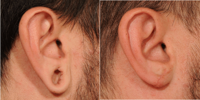 Earlobe Repair before and after photo