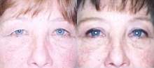 Eyelid Surgery before and after photo