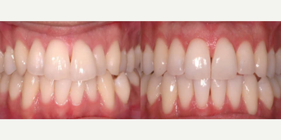 Invisalign before and after photo