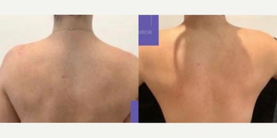 IPL before and after photo