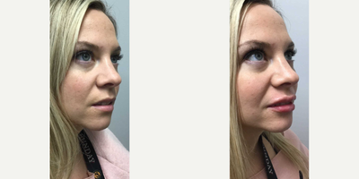 Lip Fillers before and after photo