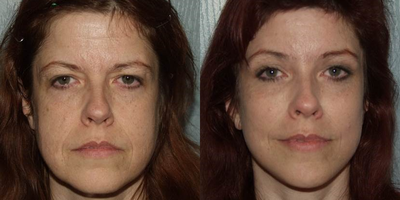 Brow Lift before and after photo