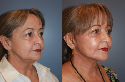 Facelift before and after photo