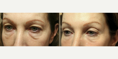 Thermage before and after photo