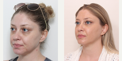 Botox before and after photo