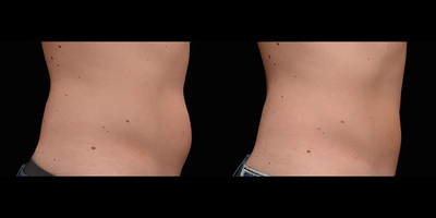 CoolSculpting before and after photo